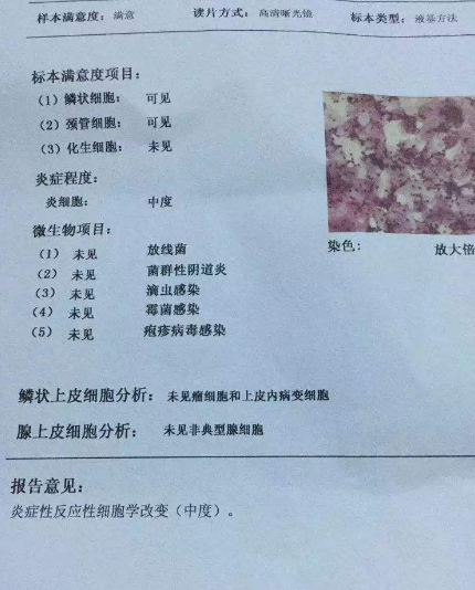 阴道分泌物麻豆影视在线直播视频厂家教你查看阴道分泌物检测报告