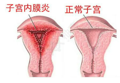 全自动阴道分泌物麻豆影视在线直播视频厂家子宫内膜炎的症状表现提前了解与预防