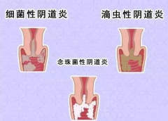 全自动阴道分泌物麻豆影视在线直播视频厂家提醒您还在拖延吗，还在等阴道炎自愈吗？